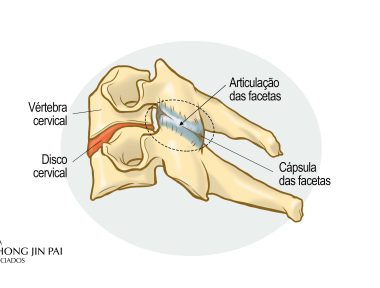 A síndrome da dor facetária é a manifestação clínica de um processo degenerativo e/ou inflamatório das articulações zigoapofizárias