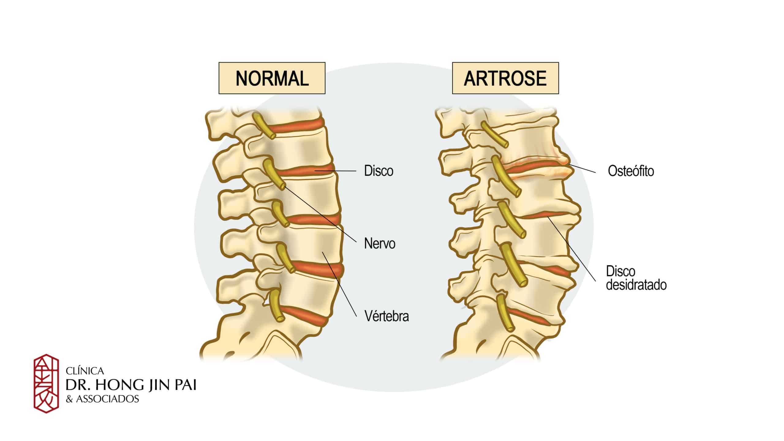 A artrose da coluna é o desgaste das articulações desta área do corpo e provoca sintomas como dor e dificuldade para movimentar
