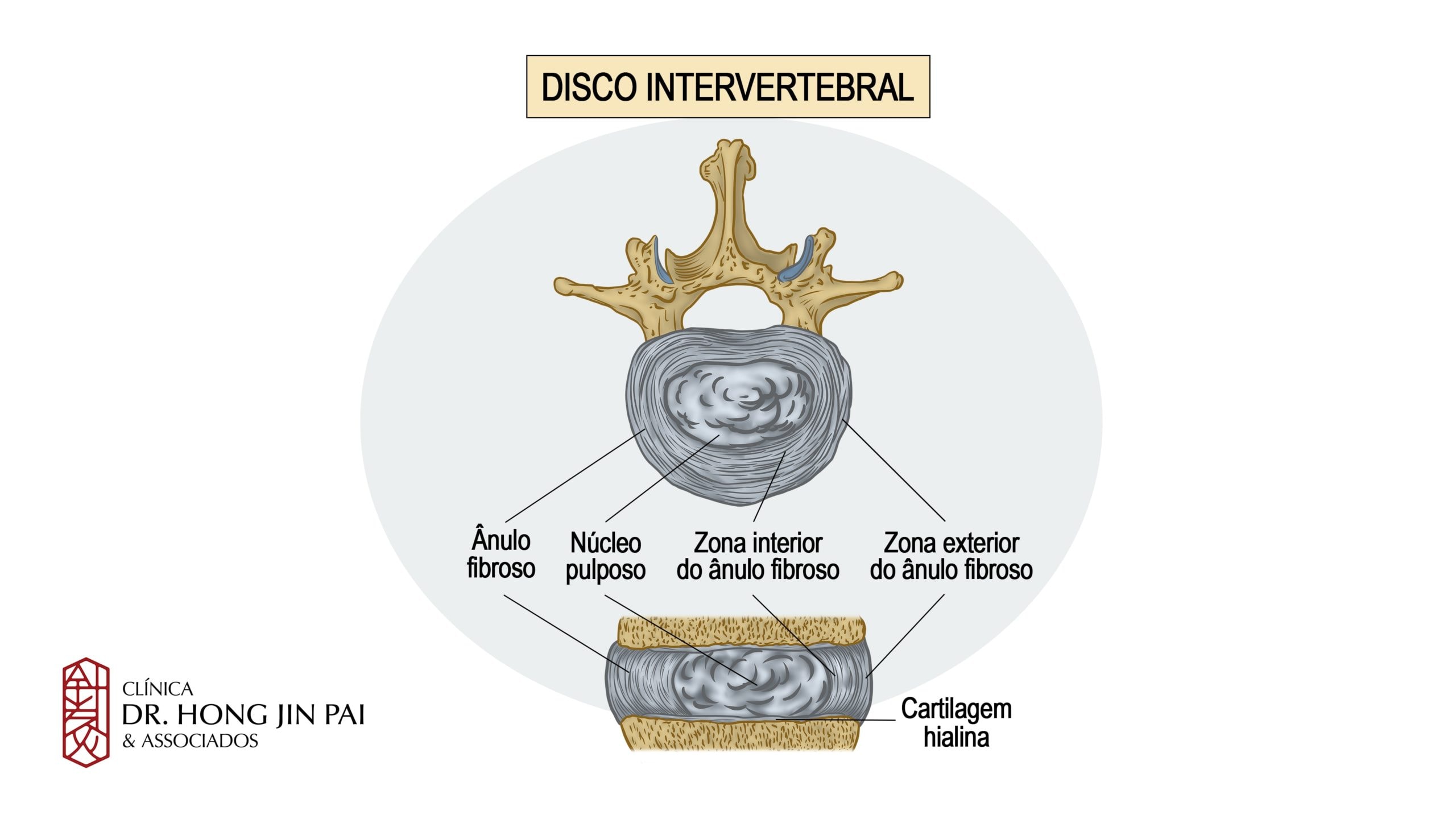 O disco intervertebral contém uma abundante matriz extra-celular de proteoglicanos e colágeno