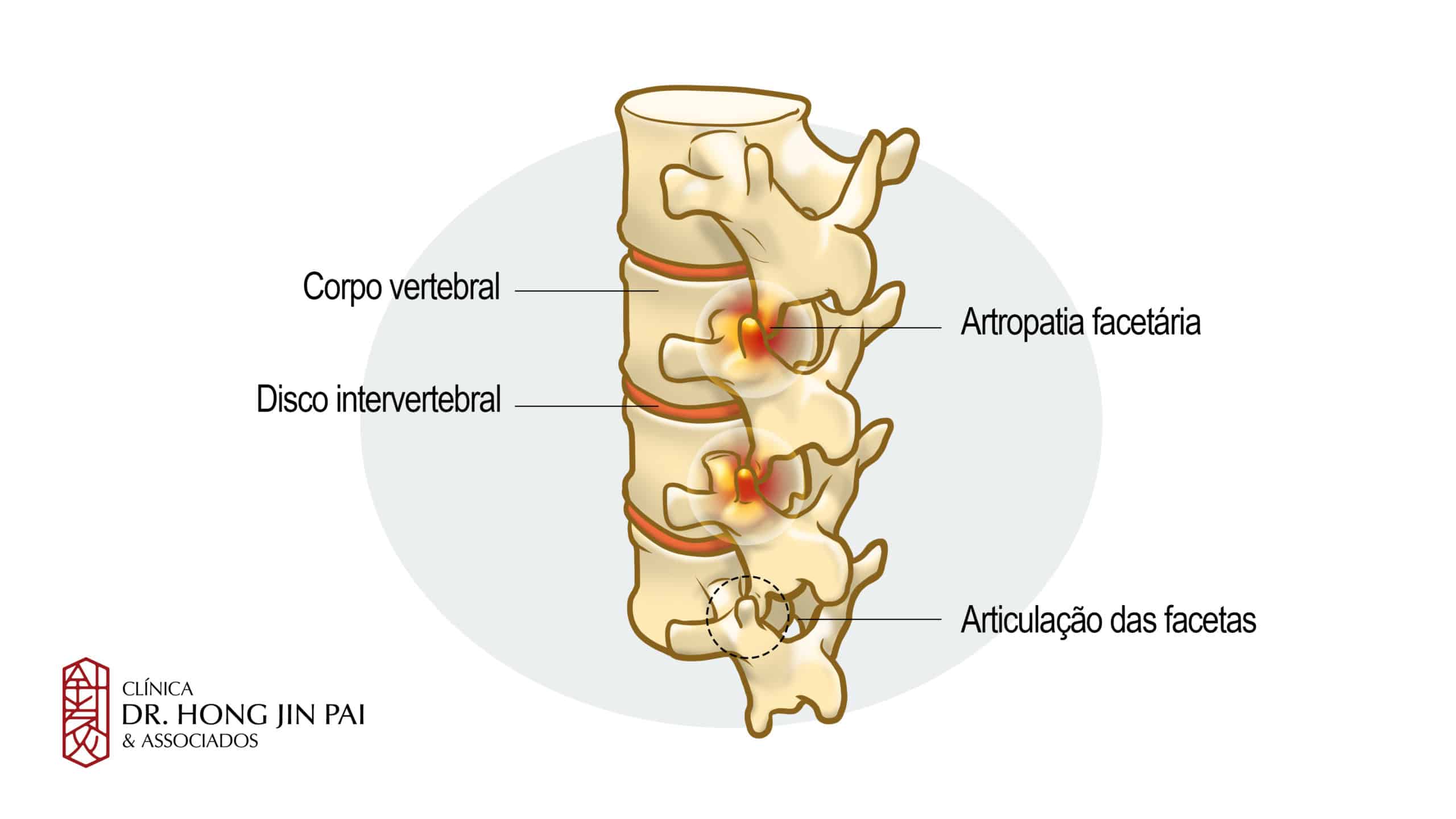 Dor Facetária. É uma condição muito comum na coluna vertebral e uma das principais causas de dor crônica