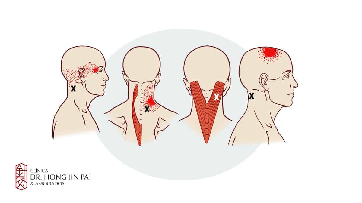 Síndrome Dolorosa Miofascial Cervical - Dor no pescoco