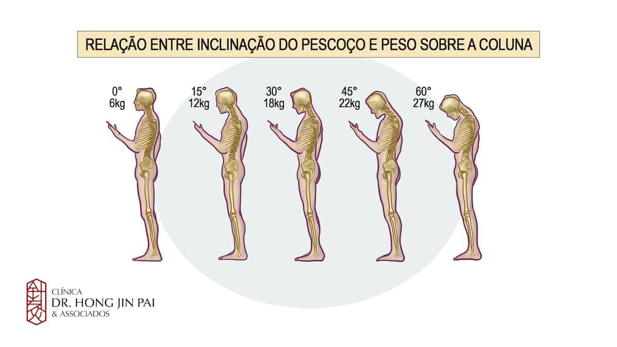 Tensão cervical e angulos no disco