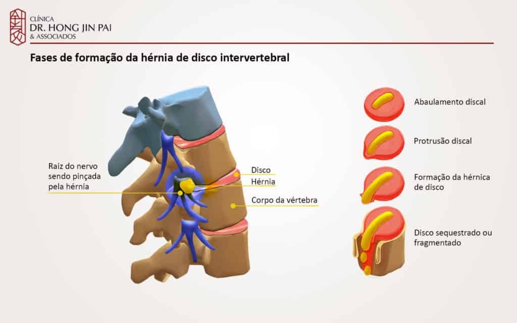 Sequência de cortes do disco intervertebral ilustrando abaulamento discal, protrusão discal, formação da hérnia de disco e disco sequestrado, ao lado de vértebras em perfil.