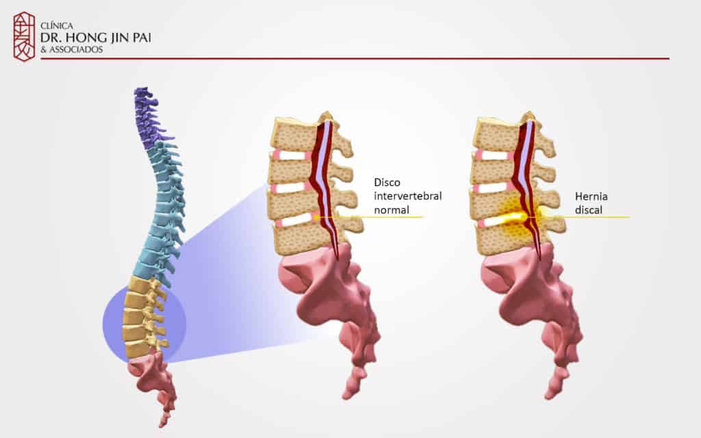 A hérnia de disco consiste em uma extrusão do disco vertebral. Normalmente contendo o núcleo pulposo do disco intervertebral envolvido pelo anel fibroso em estágio avançado de degeneração. As estruturas nervosas estão comprometidas pelo estreitamento dos canais por onde passam os nervos (estenose), medula ou saco dural (canal medular).