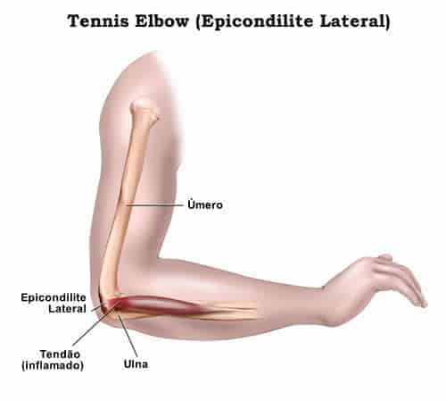 inflamație a tratamentului epicondilitei articulare la cot articulația superioară a umărului doare