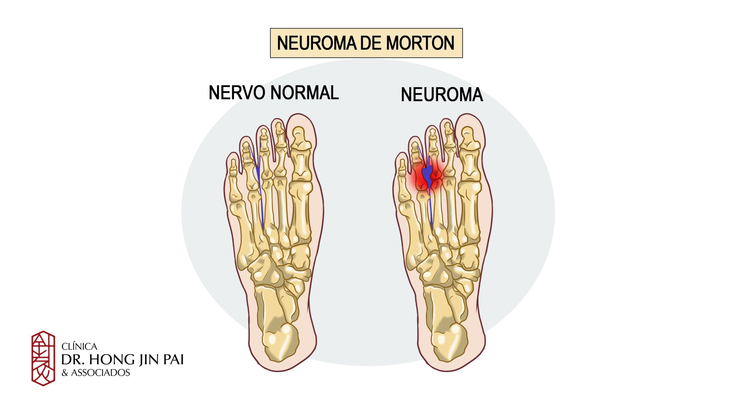 Inflamação nervo neuroma de morton