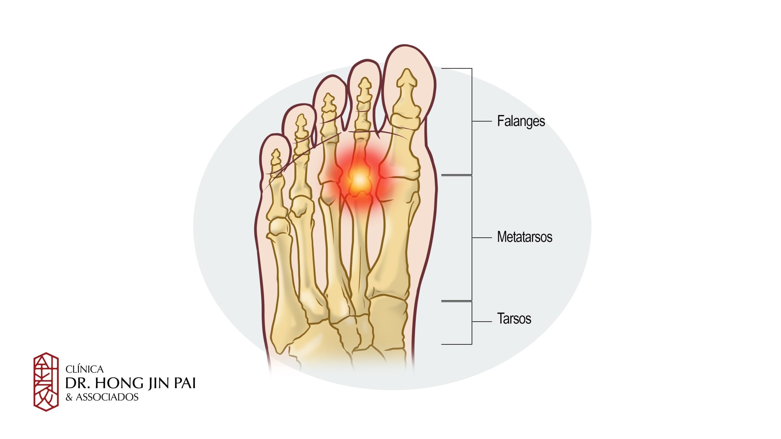 A metatarsalgia é uma dor na parte frontal do pé, localizada na área dos ossos metatarsos, que são os ossos que articulam com as falanges