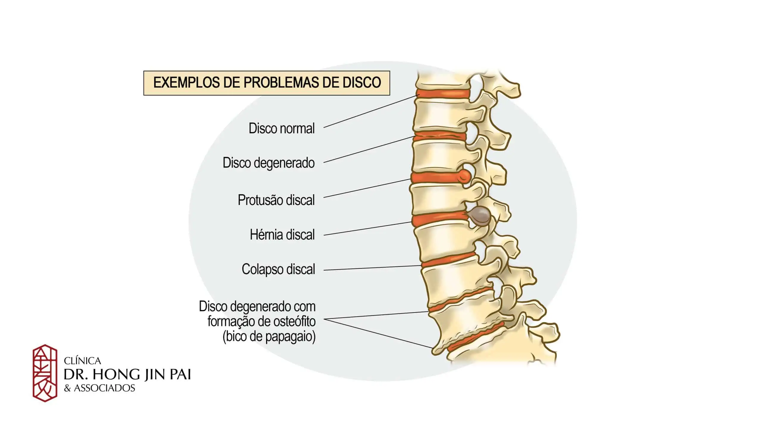 Artrose, bico de papagaio, osteofito, degeneração do disco