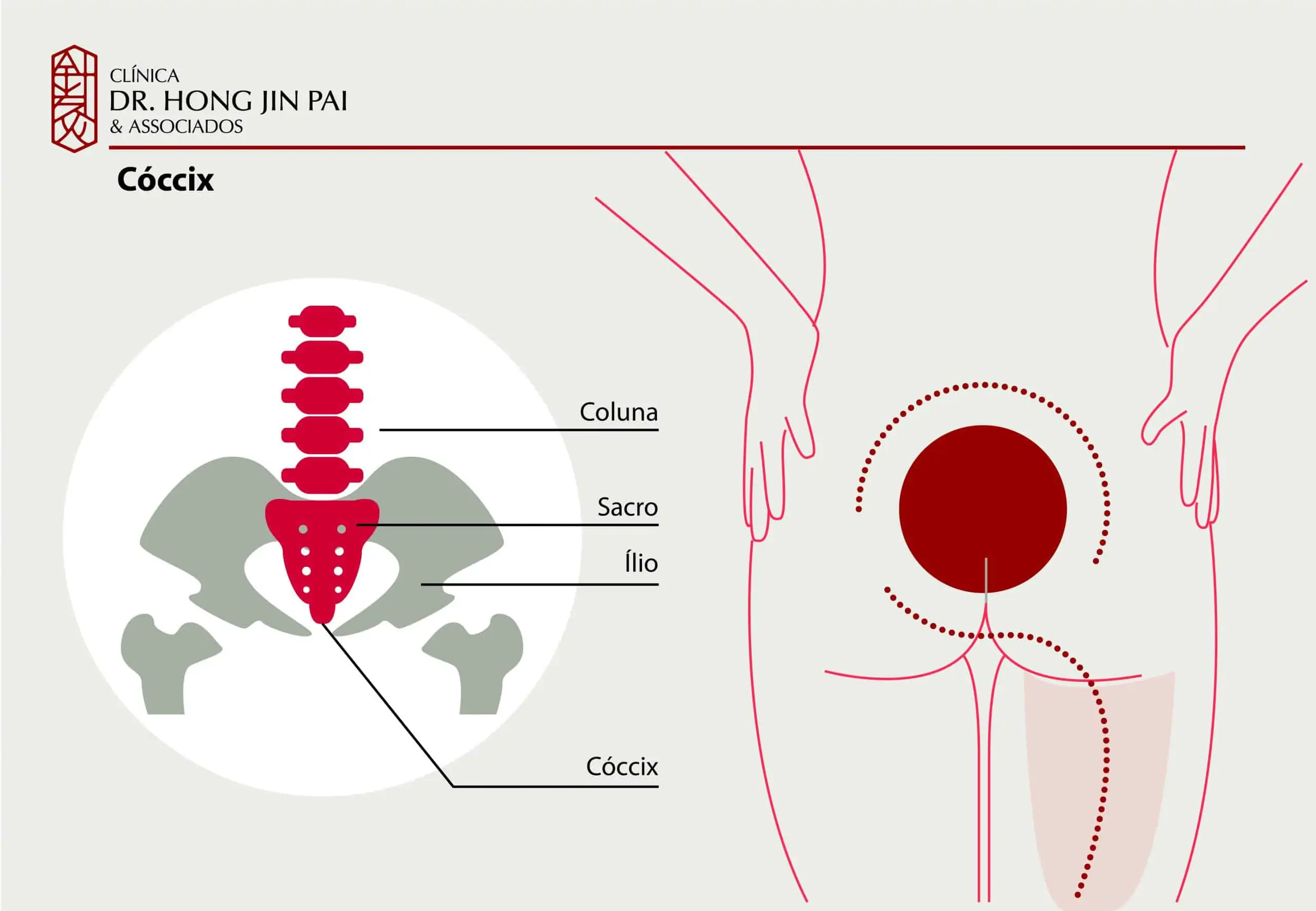 Infografico Dor no Coccix Coccidinia scaled