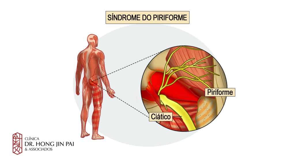 SÍNDROME DO PIRIFORME