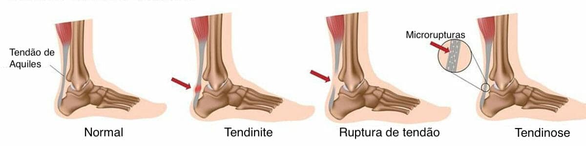 TENDINITE TENDINOSE