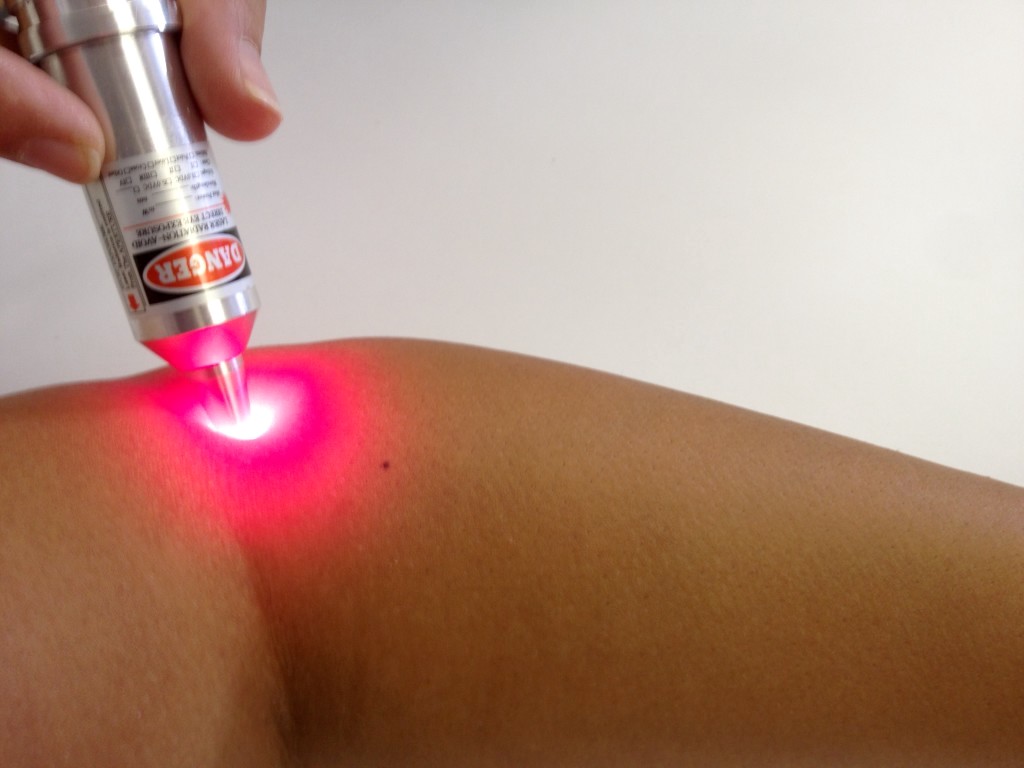 acupuntura laser bebes criancas