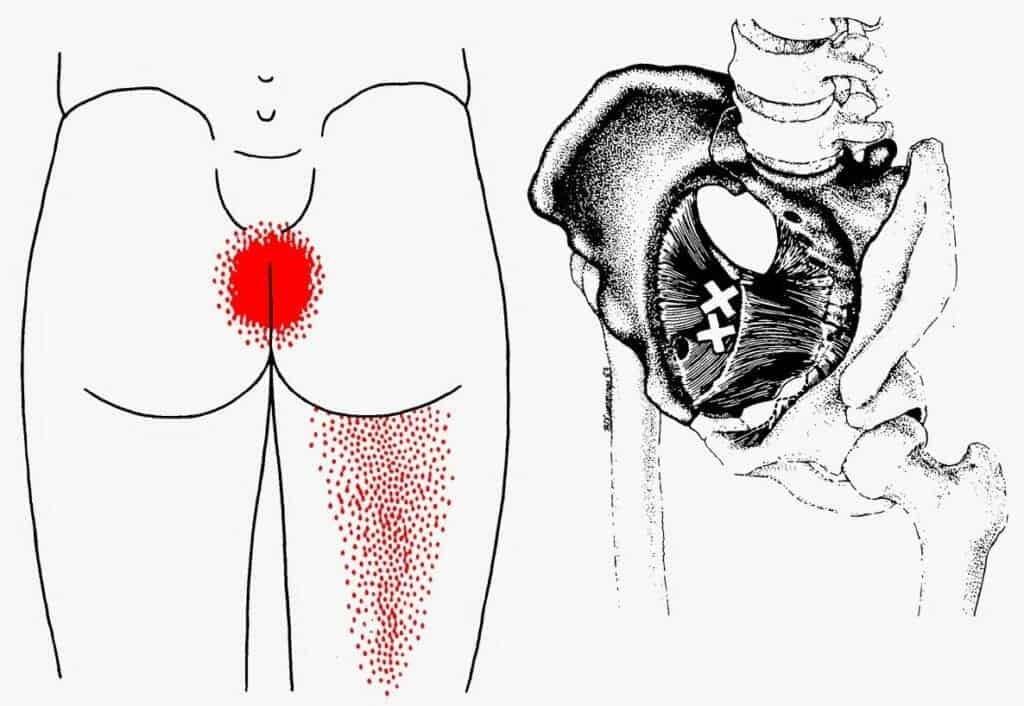 Desenho da região das nádegas com mancha vermelha sobre o cóccix e padrão de dor descendo pela coxa, ao lado de ilustração da musculatura do assoalho pélvico com pontos-gatilho marcados por X.