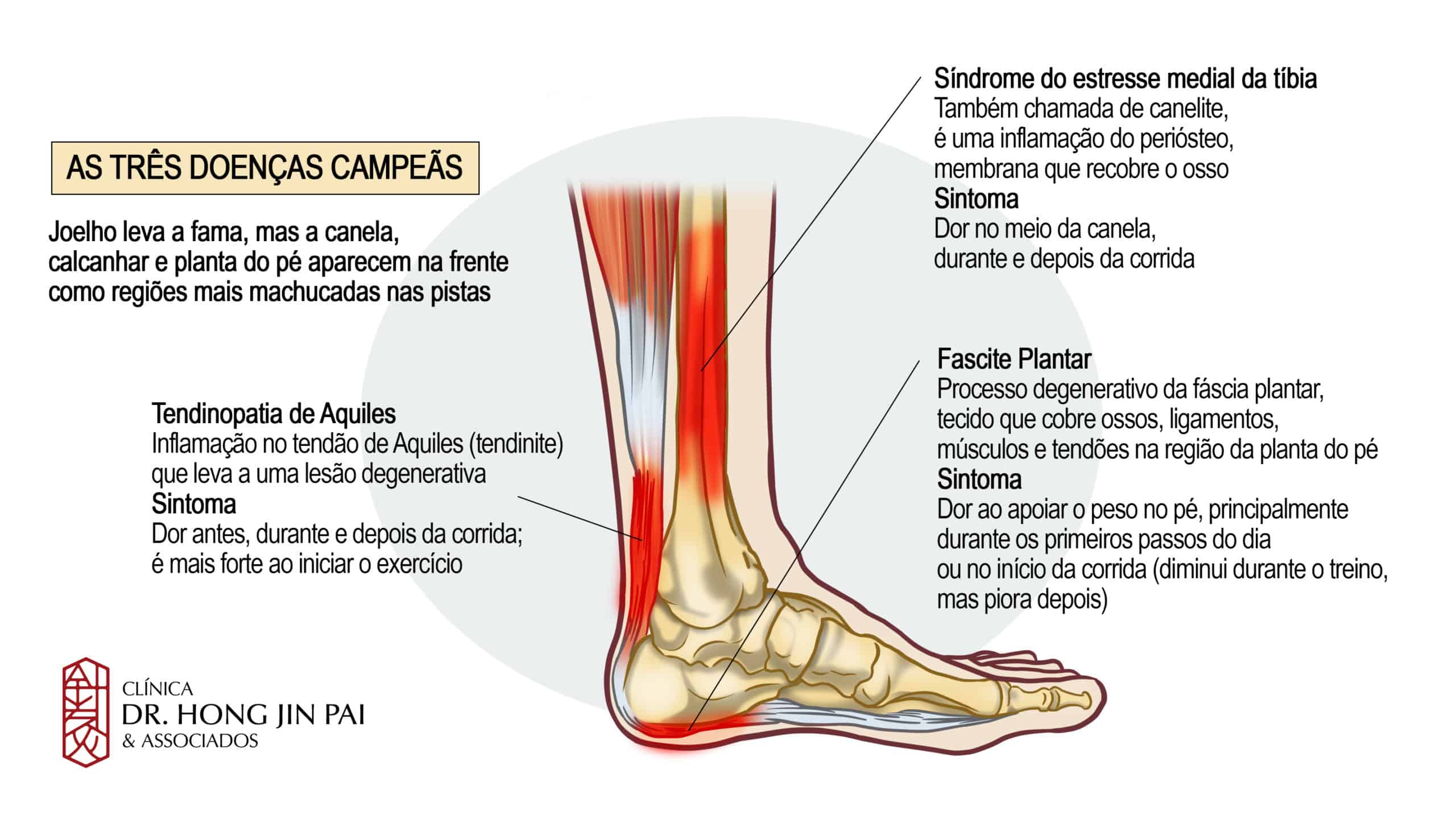 A dor no calcanhar pode ser devida à fascite plantar (inflamação da fáscia plantar), ao esporão do calcâneo, fratura de stress do calcâneo, entorse do tornozelo