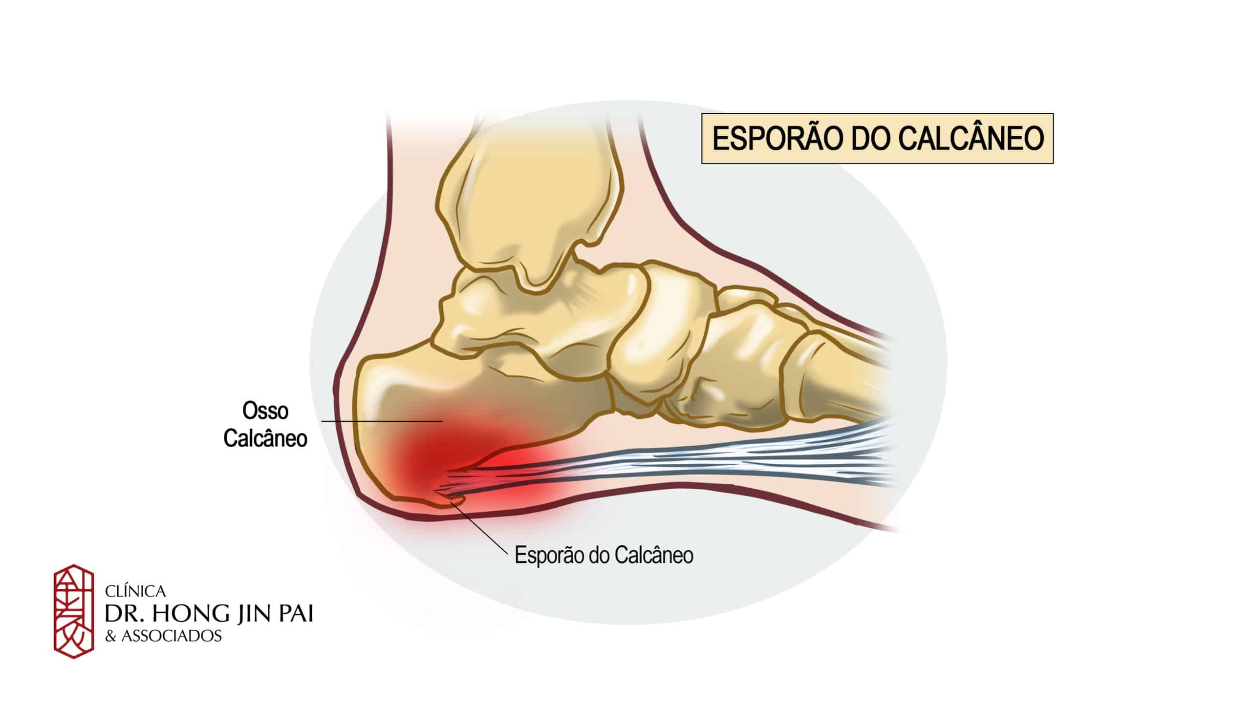 O esporão do calcâneo é resultado do crescimento anormal de uma parte do osso do calcanhar. Pode causar dor muito forte