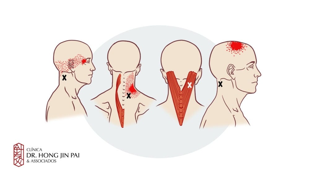 Dor referida Cervicalgia e cefaleia tensional dor miofascial