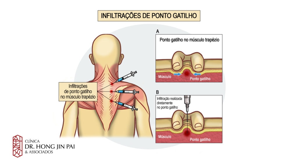 Infiltracoes de pontos gatilhos