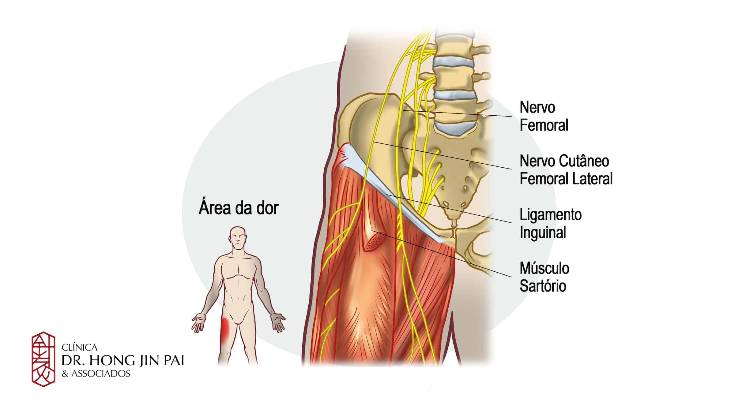 Meralgia parestesica pode dar dor e formigamento na regiao anterior da coxa