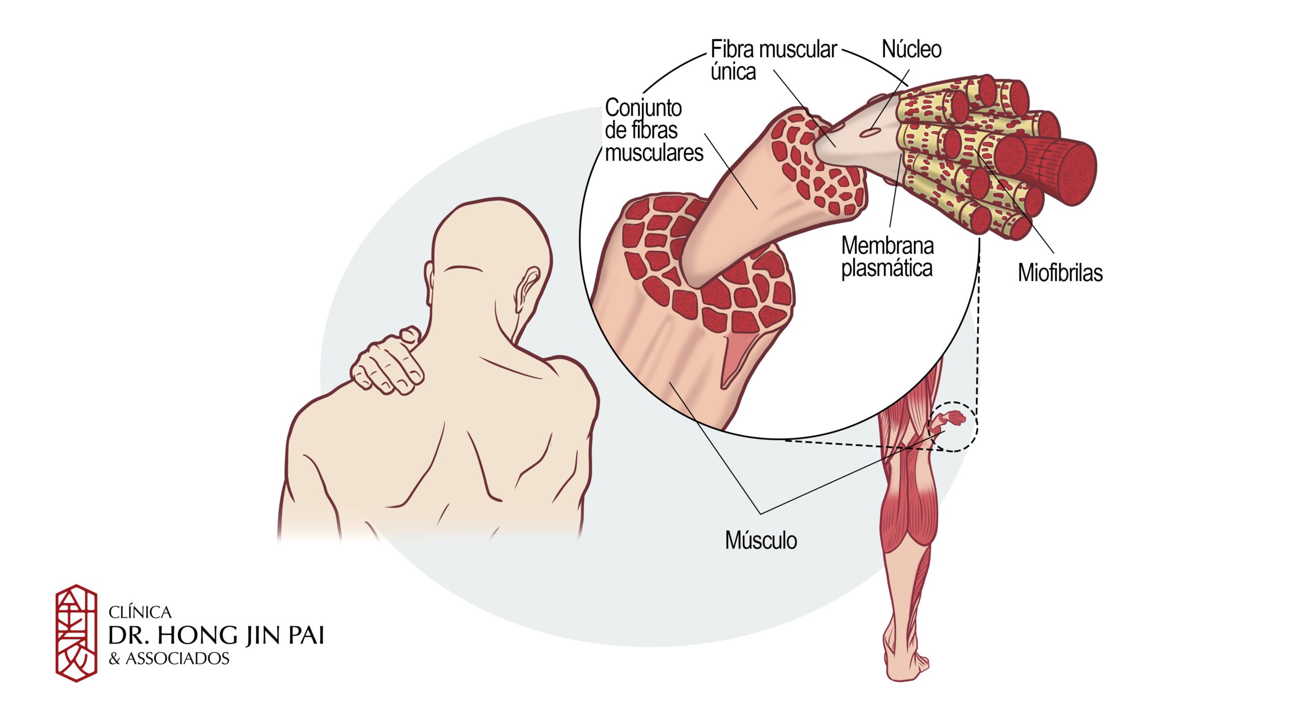 Sindrome Dolorosa Miofascial