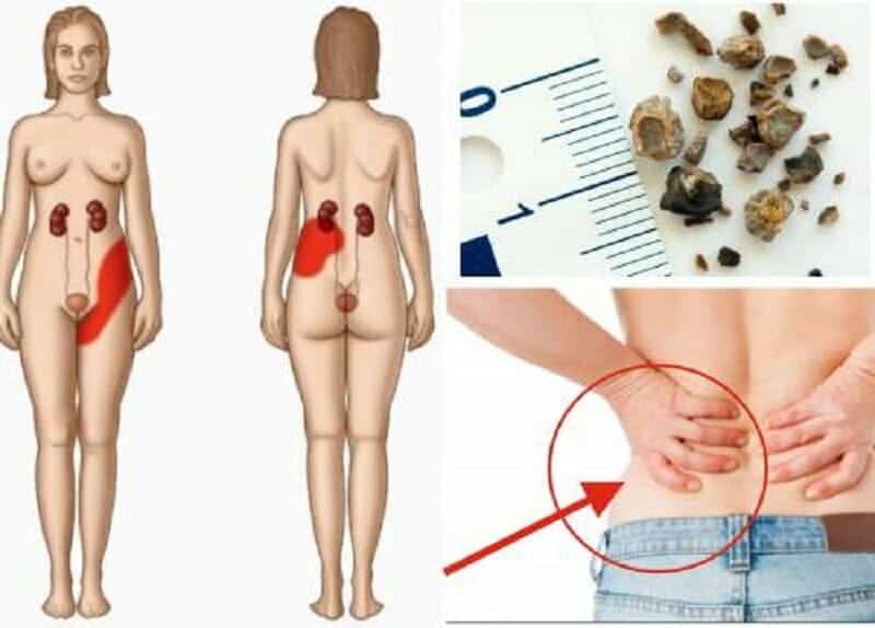 Mapa do corpo de frente e de costas com a área de dor renal destacada em vermelho irradiando para a virilha, ao lado de cálculos renais sobre uma régua.