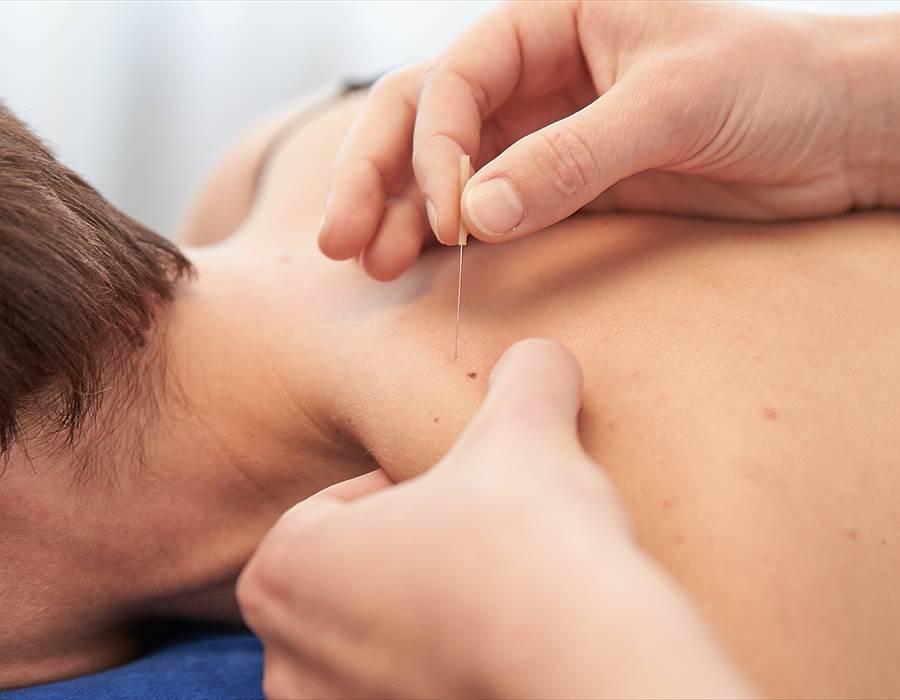 dry needling agulhamento seco