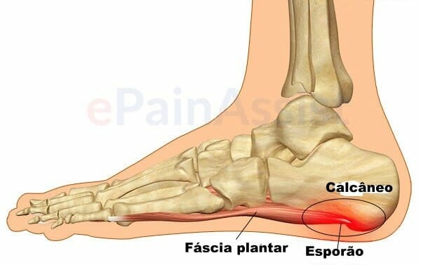 fascite plantar esporao tratamento