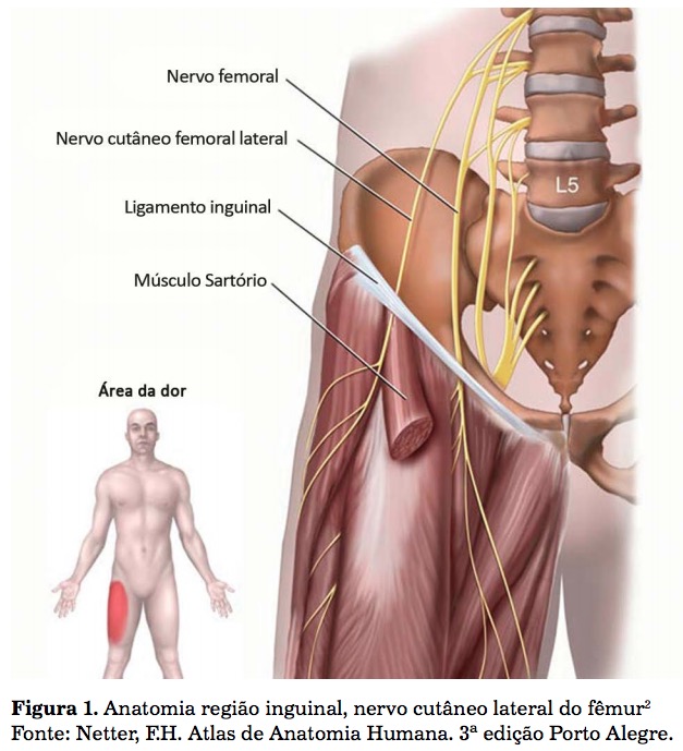 Ilustração anatômica da região inguinal mostrando o nervo cutâneo femoral lateral, o nervo femoral, o ligamento inguinal e o músculo sartório, com figura corporal indicando a área da dor na coxa.