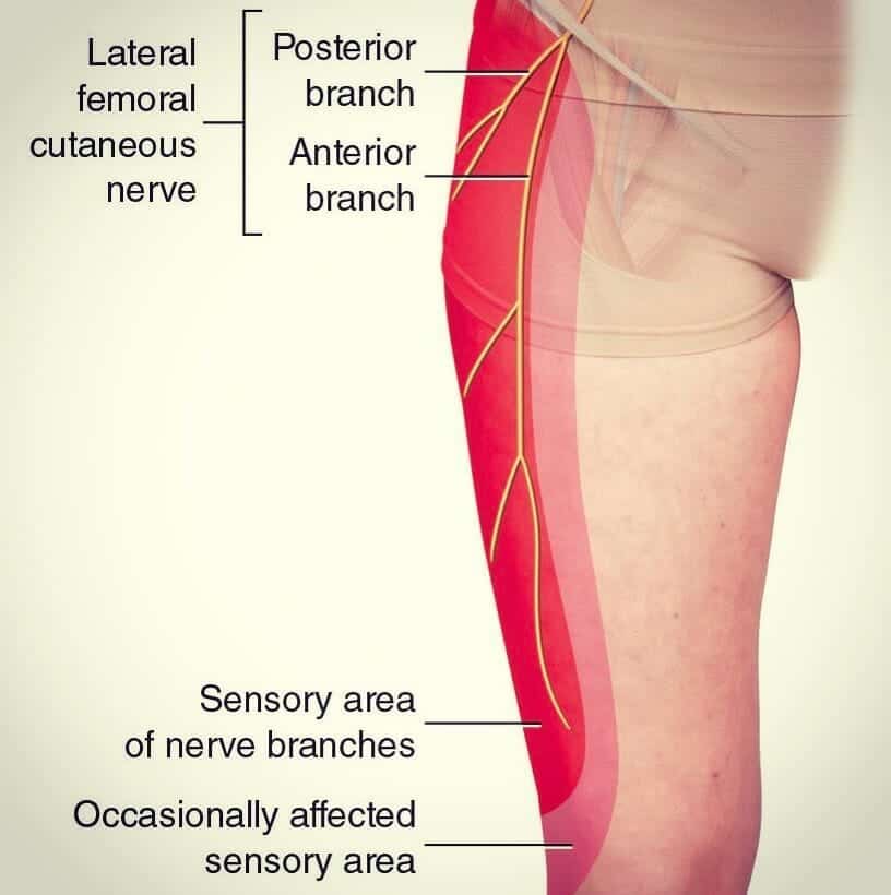 Diagrama de perfil da coxa com os ramos anterior e posterior do nervo cutâneo femoral lateral e a área sensitiva afetada destacada em vermelho na face lateral da coxa.