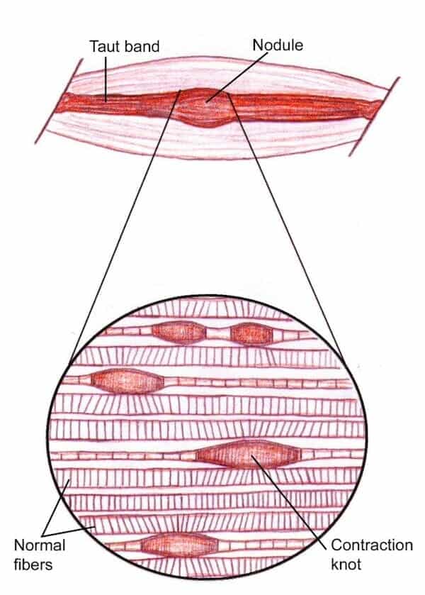 Dry Needling ou Agulhamento Seco O que você precisa saber Clínica