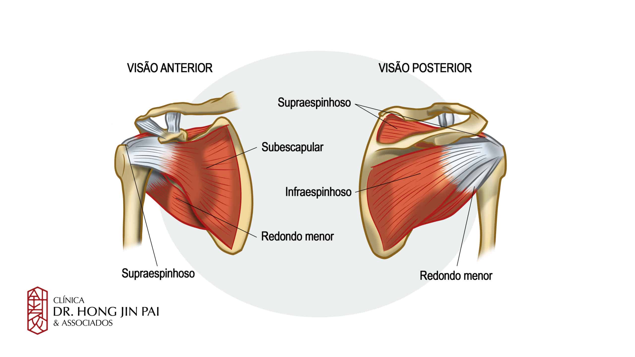 A tendinite do manguito rotador (ombro de tenista) afeta os tendões localizados nos ombros.