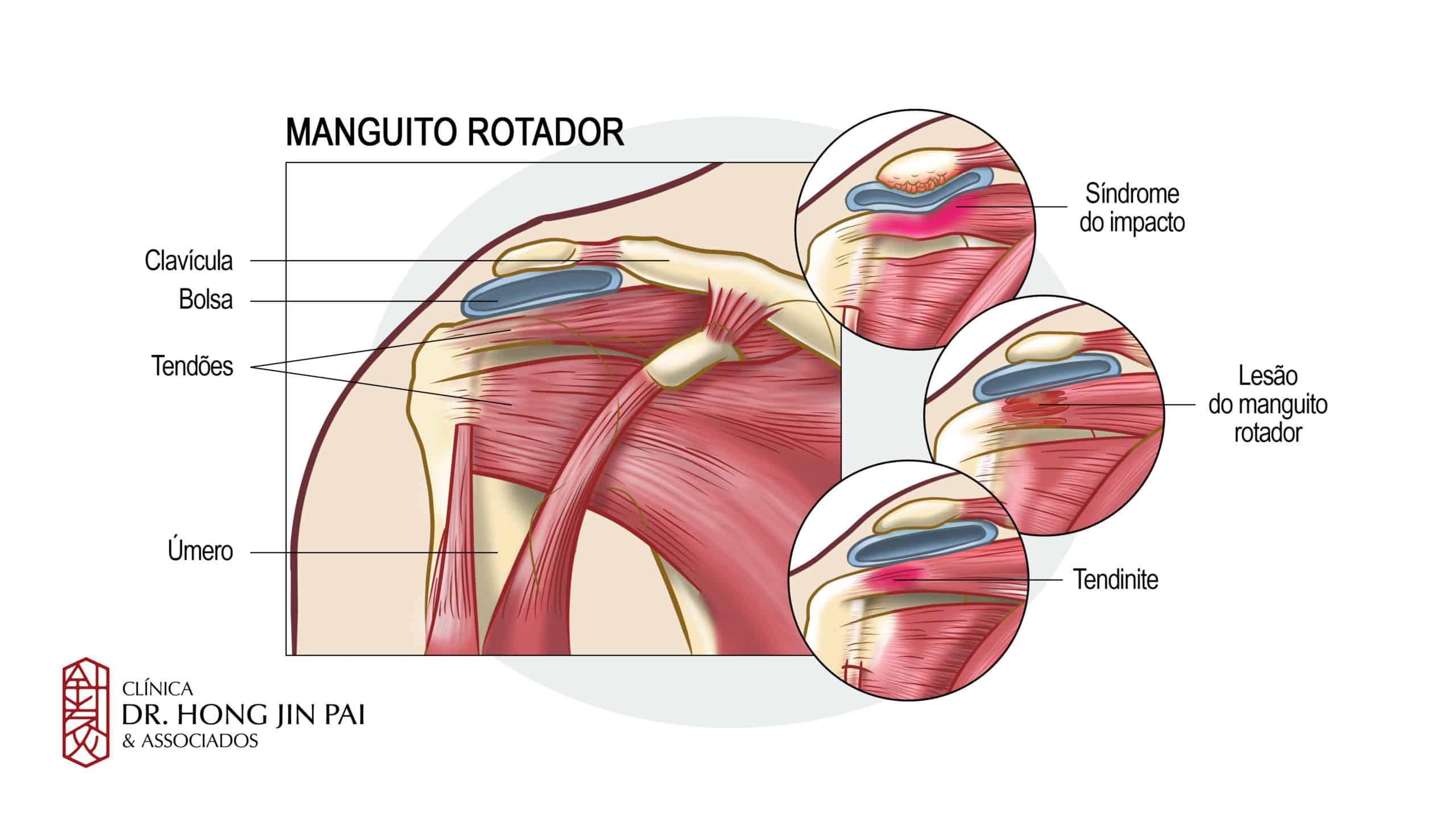 A síndrome de manguito rotador é uma causa frequente de dor no ombro, causada por tendinite ou ruptura dos tendões