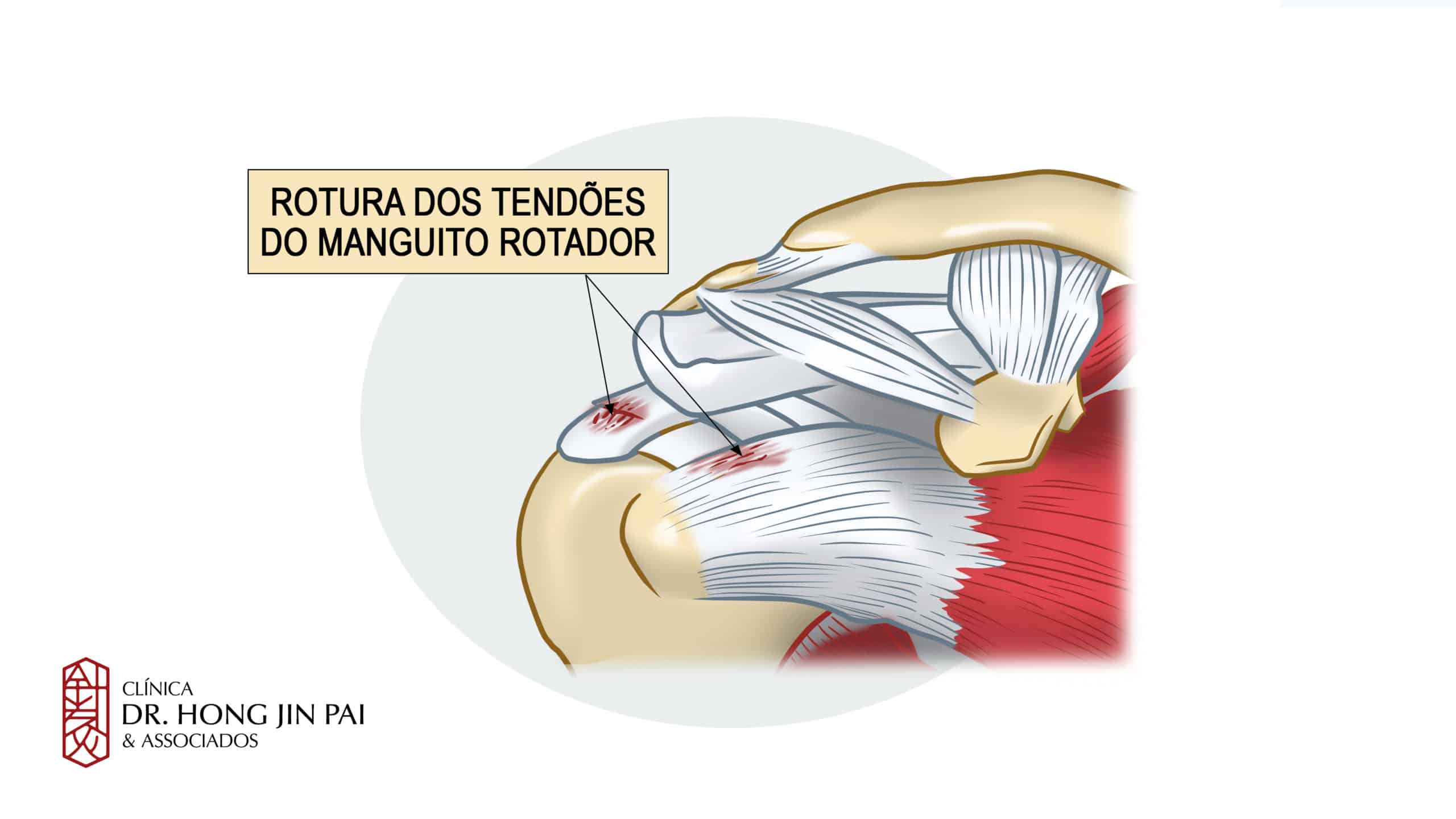 A lesão do manguito rotador (LMR) é comum na prática ortopédica, responsável por cerca de 70% dos quadros de dor no ombro