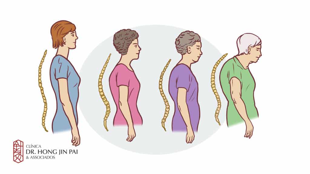 Ilustração da Clinica Dr. Hong Jin Pai com quatro figuras femininas em perfil, da mais jovem e ereta a mais idosa e curvada, com a coluna ao lado mostrando o aumento progressivo da curva.