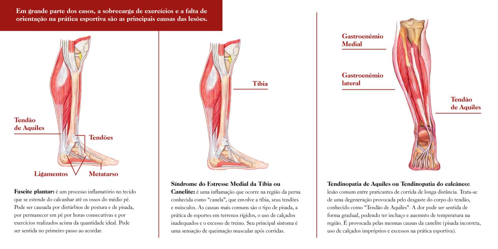 O sintoma característico da fascite plantar é uma dor forte, em facada, perto do calcanhar.