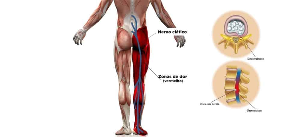 Vista posterior do corpo com o trajeto do nervo ciático em azul descendo da coluna lombar até o pe, zonas de dor em vermelho na perna, e dois detalhes ampliados de disco saudável e disco com hernia comprimindo a raiz.