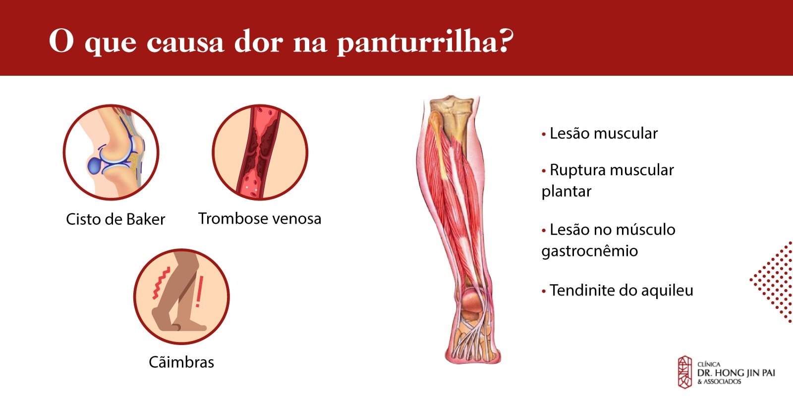 Infografico causas de dor na panturrilha
