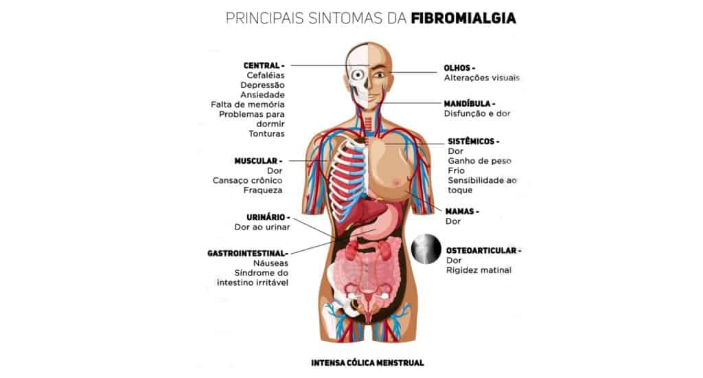 Diagrama de um corpo humano com órgãos internos e setas que ligam regiões a grupos de sintomas da fibromialgia, como central, ocular, mandibular, muscular, urinário, gastrointestinal e osteoarticular.
