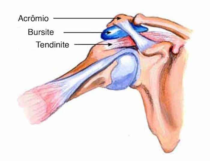 Bursite: O que é? Causas, sintomas e tratamentos | Clínica Dr. Hong Jin ...