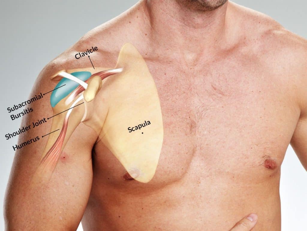 Ilustração sobreposta a um torso mostrando bursite subacromial, com clavícula, articulação do ombro, úmero e escápula identificados.