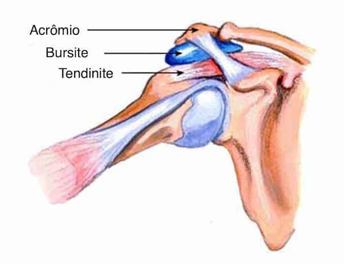 inflamația bursitei mucoasei articulare oasele articulare doare