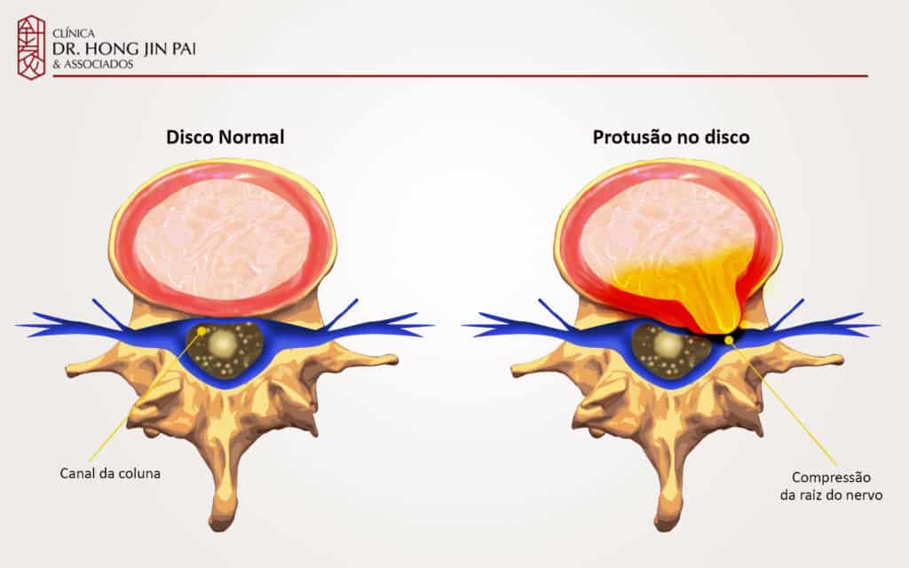 Diagrama em corte axial mostrando um disco normal ao lado de um disco com protusao comprimindo a raiz do nervo no canal da coluna