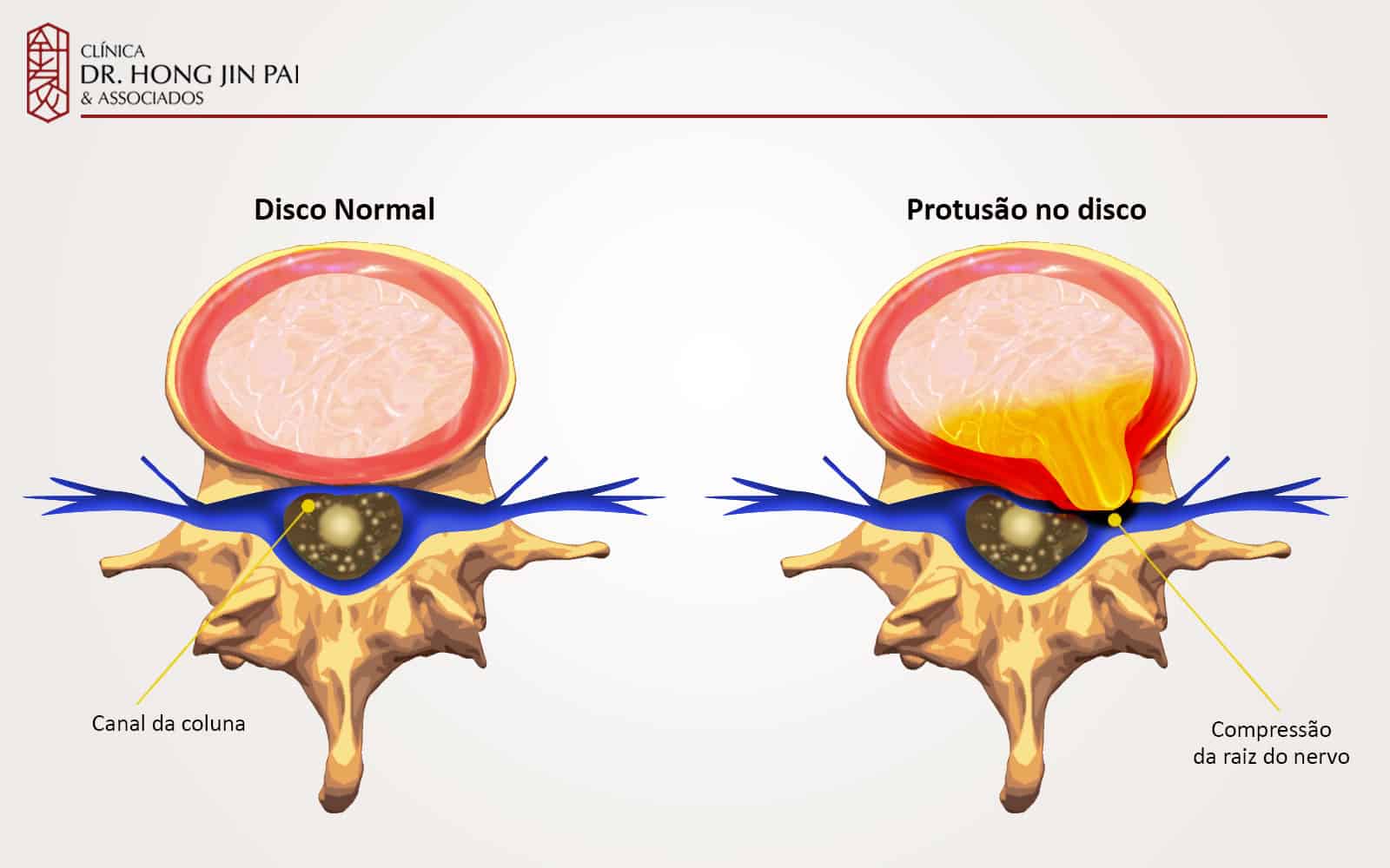 Na chamada protrusão discal, o anel fibroso não se rompe, apenas se distende. Nessa fase, o abaulamento do disco pode pressionar a raiz e gerar dor