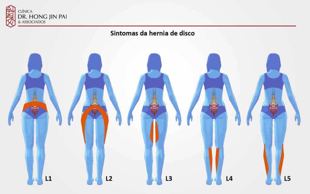 Cinco silhuetas femininas vistas de costas, marcadas L1 a L5, com faixas laranja mostrando onde a dor e a perda de força se irradiam conforme a raiz nervosa lombar afetada