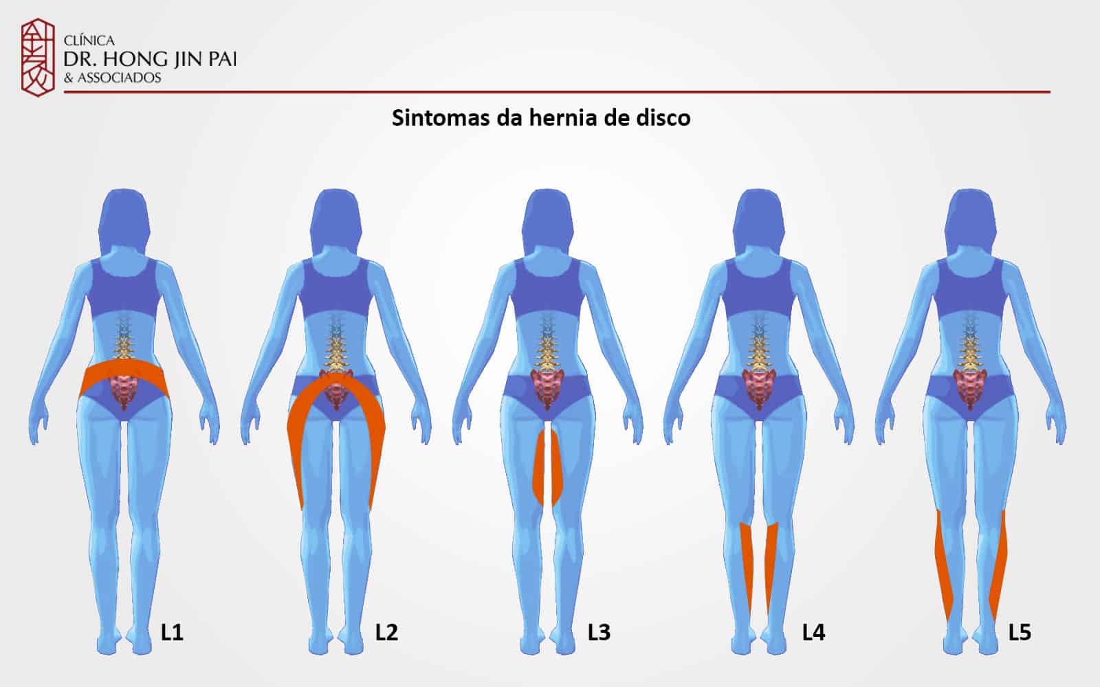 Lesões e doenças podem fazer pressão na medula espinhal, causando dor nas costas, formigamento, fraqueza muscular e outros sintomas.