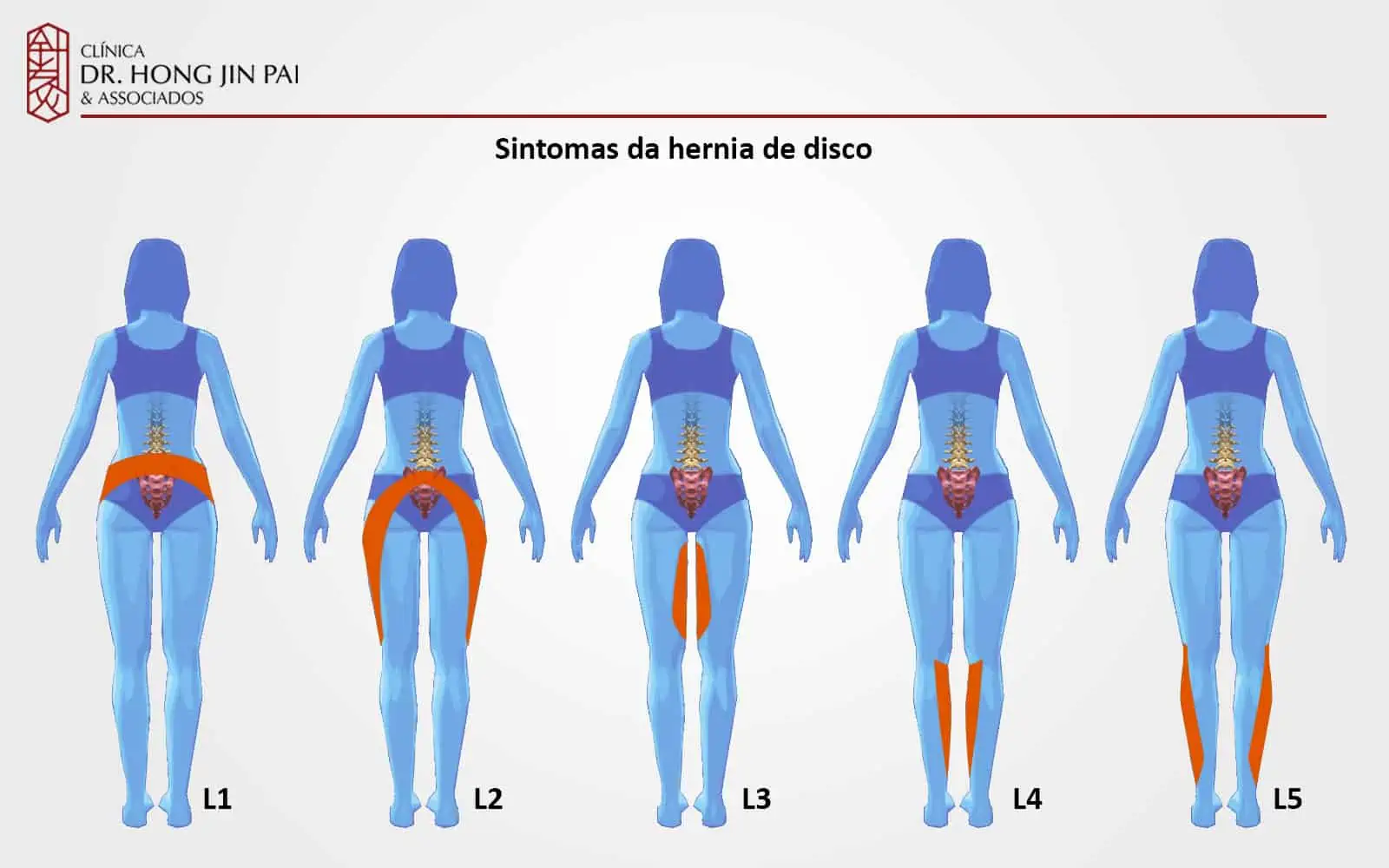 Padrao de dor ciatica depende da altura da lesão do disco