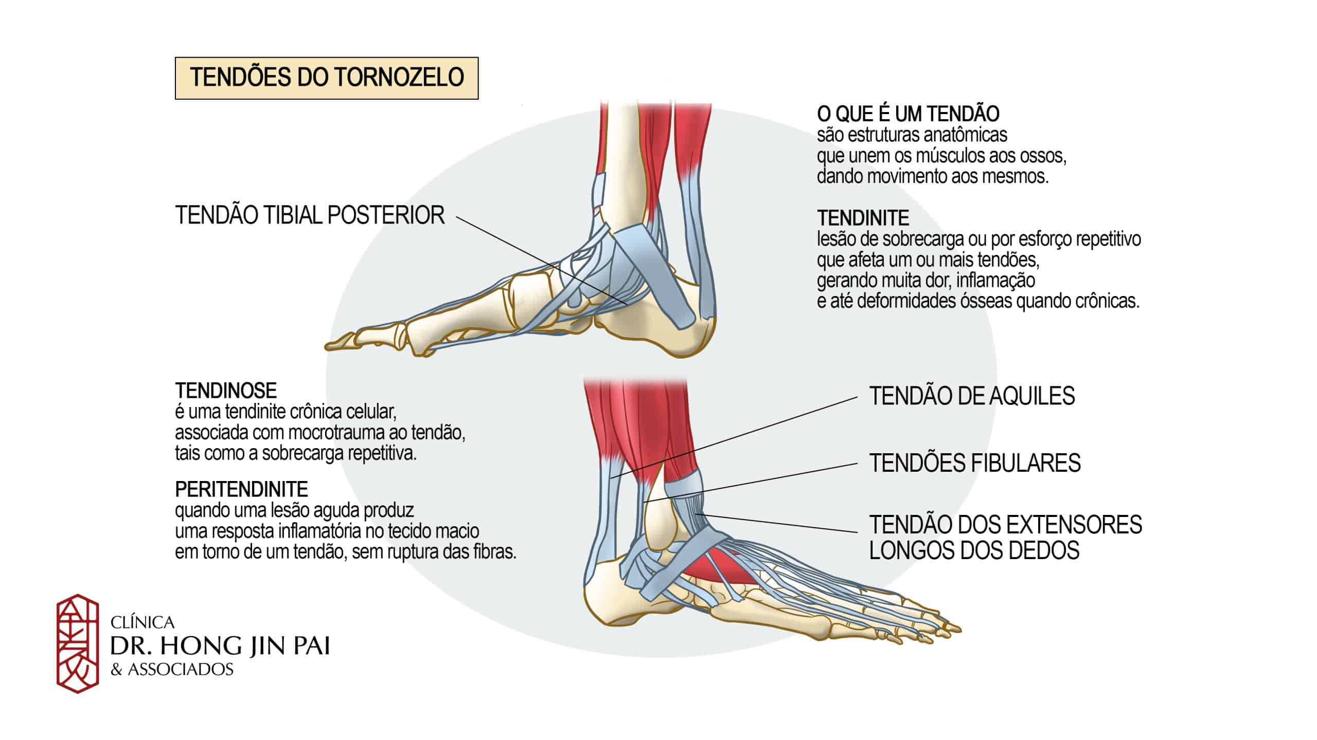 Pe Tendinoptias e Tendoes Tornozelo