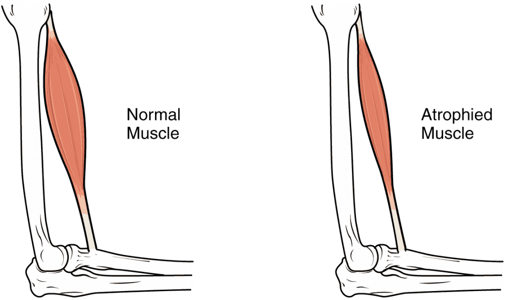 Ilustração comparando o antebraço com musculo normal e cheio ao lado do mesmo musculo atrofiado e reduzido de volume