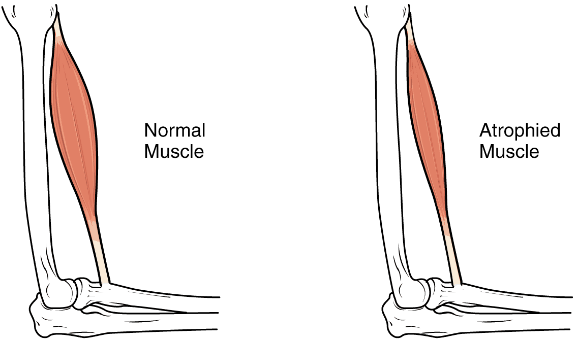 atrofia muscular