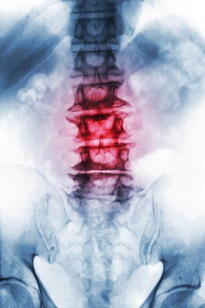 Radiografia frontal da coluna lombar com as vértebras centrais realçadas em vermelho, sobre a pelve.