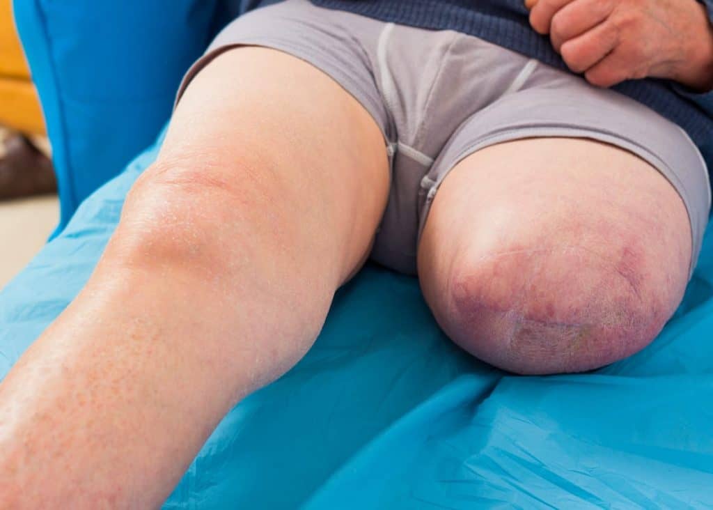 Coto de amputação acima do joelho cicatrizado, com pele arroxeada na extremidade, ao lado da perna intacta sobre lençol azul